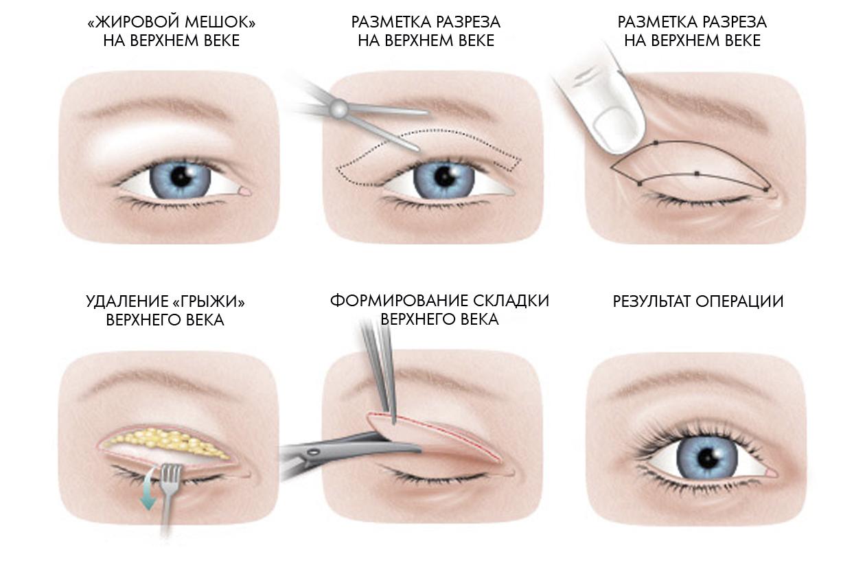 Веки морщины как убрать. Блефаропластика верхних век схема. Методики блефаропластики верхних век. Пластика верхних век (верхняя блефаропластика) (2 схема). Трансконъюктивальная пластика нижних век.