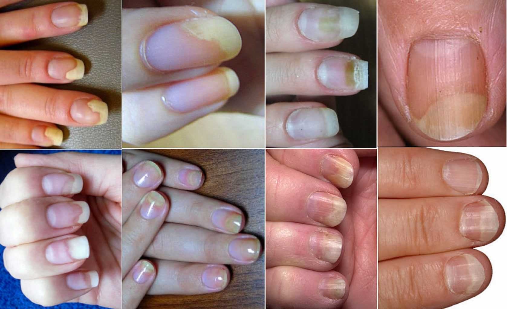 Примеры онихолизиса ногтей