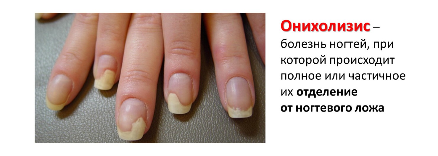 Онихолизис ногтей после гель-лака