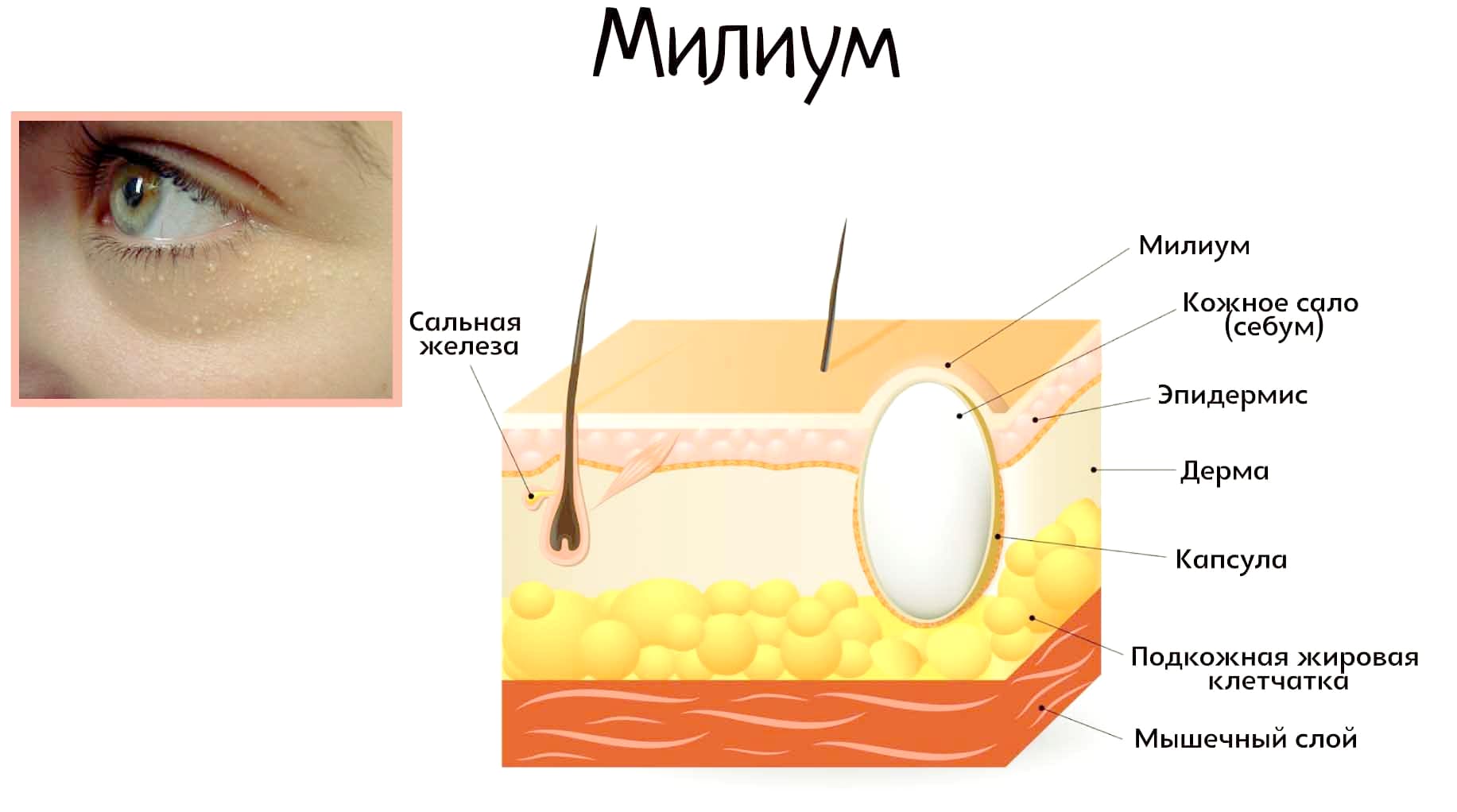 Милиумы на коже: причины появления и способы лечения