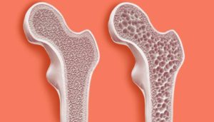 Остеопороз у женщин: причины, лечение и профилактика