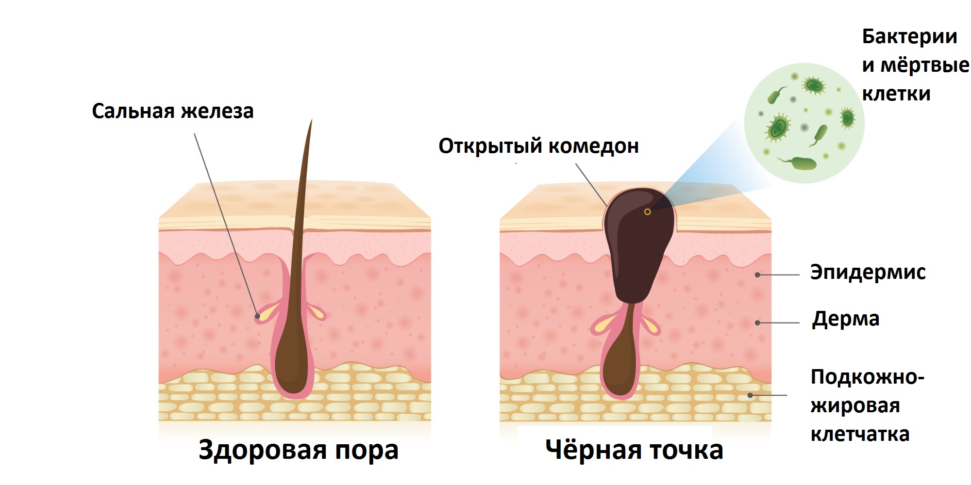 Черные точки и сальные нити: в чем разница и как избавиться от них